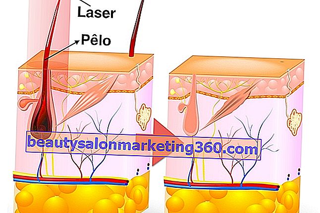Ako funguje laserové odstránenie chĺpkov