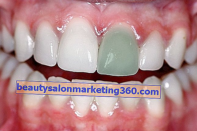 Diş rengi ne kadar koyulaşabilir ve tedavisi nasıl yapılır