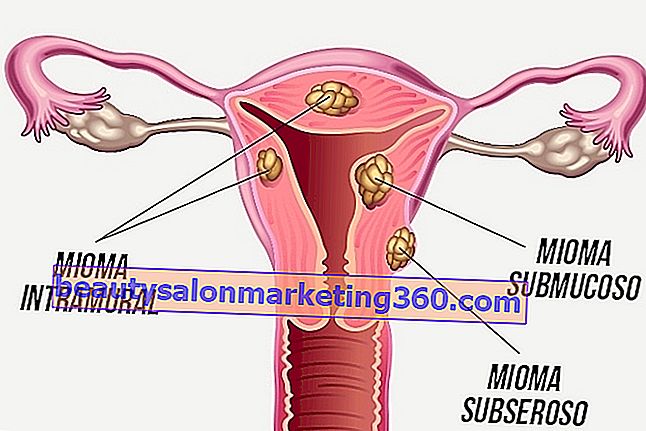 Remedii pentru fibrom în uter