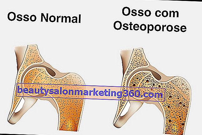 Lijekovi za osteoporozu