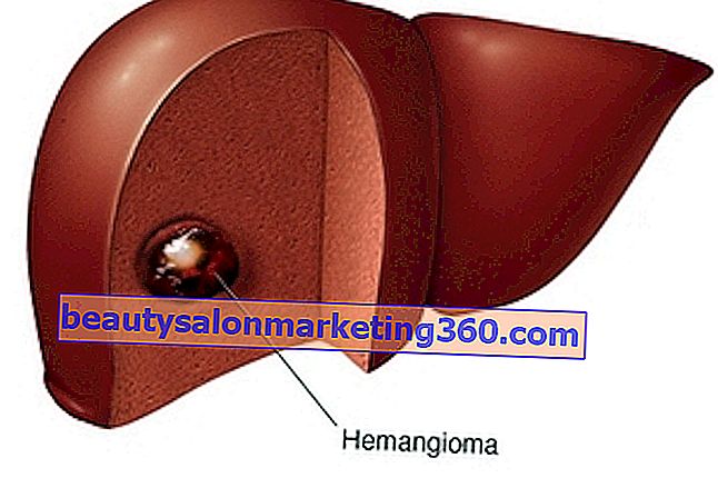 Hemangioma u jetri