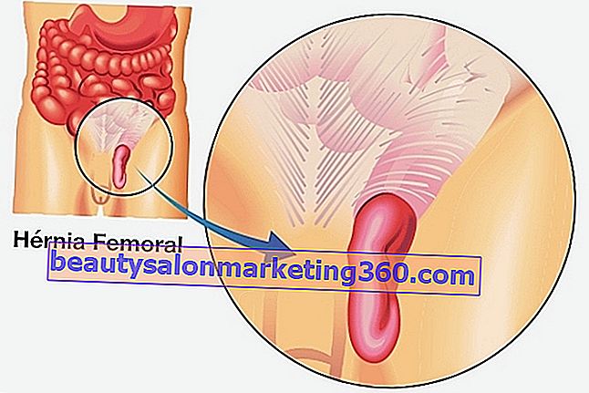 Principali sintomi dell'ernia femorale, cause e modalità di trattamento
