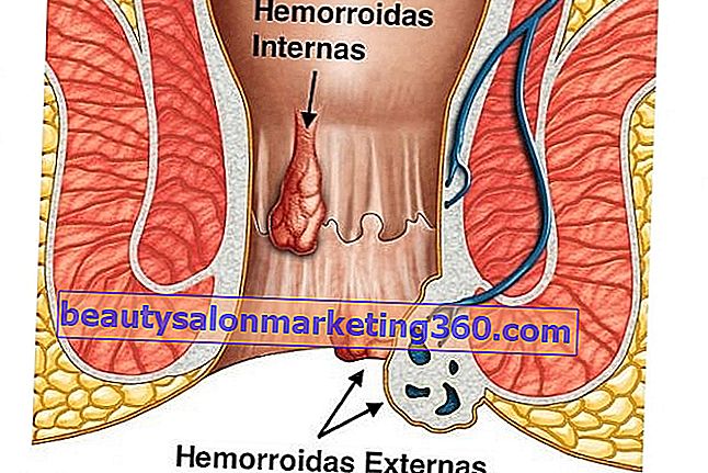 6 mogućnosti liječenja vanjskih hemoroida