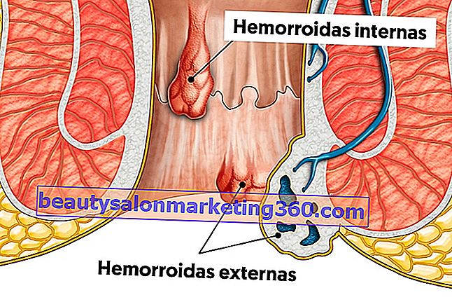Što su vanjski hemoroidi, glavni uzroci i liječenje