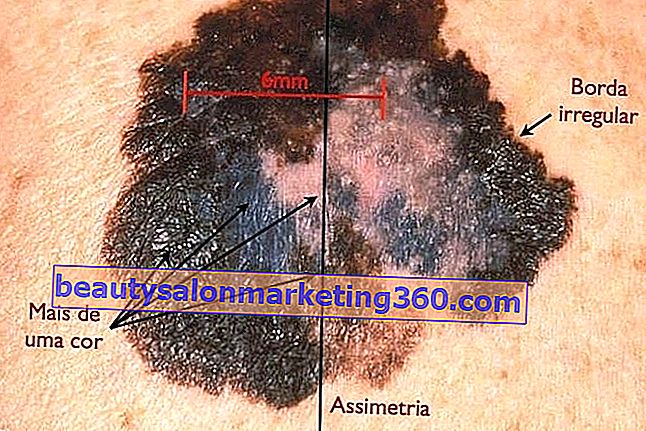 Tretmani za uklanjanje tamnih mrlja na koži