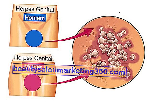 Prenos genitálneho herpesu: ako ho získať a ako sa mu vyhnúť