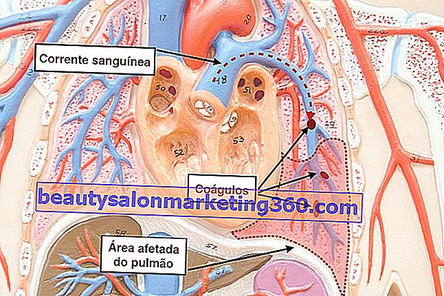 Tüdő trombózis: mi ez, fő tünetek és kezelés