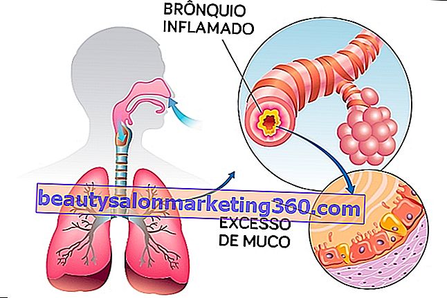 Bronhia inflamată și excesul de mucus sunt legate de astm