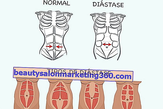 Diastasi addominale: cos'è, come identificarla e cosa fare