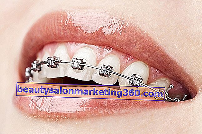 Tipi di apparecchi ortodontici e per quanto tempo utilizzarli