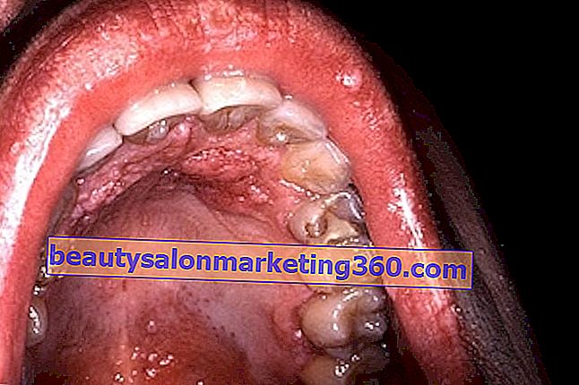 Come identificare e trattare l'HPV in bocca