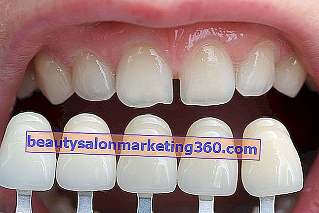 Zubne ljuskice od smole ili porculana: prednosti i nedostaci
