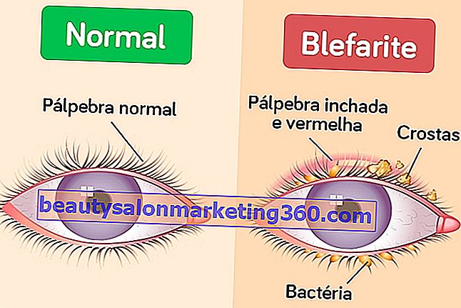 Szemhéjszéli gyulladás (blepharitis) | Szemészeti Klinika, Látás a szem sarkán