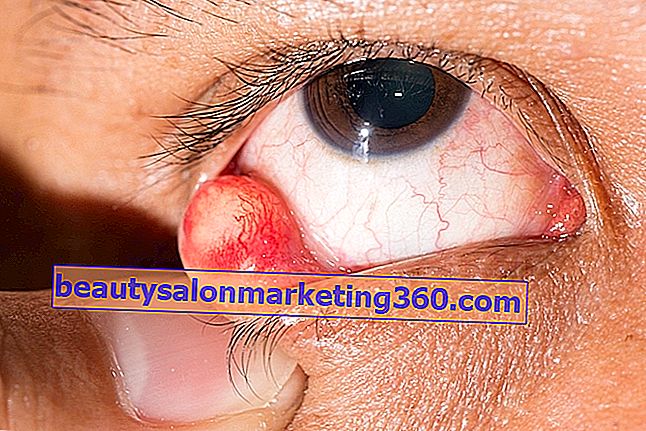 Chalazion u oku: što je to, glavni simptomi i liječenje