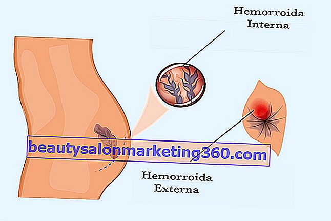 Domaći lijekovi za hemoroide