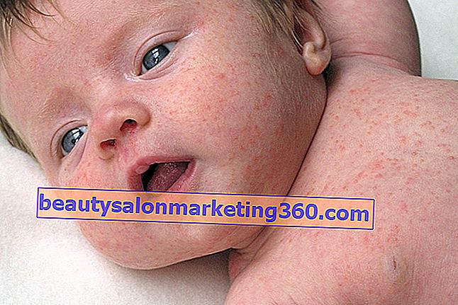 아기 피부 알레르기 : 주요 원인, 증상 및 대처 방법