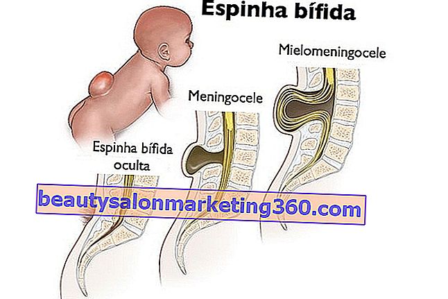Spina bifida nedir ve nasıl tedavi edilir