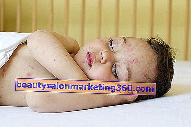 Sintomi della varicella del bambino, trasmissione e come trattare