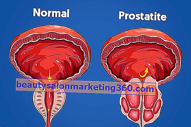 Hvad er prostatitis, symptomer og behandling