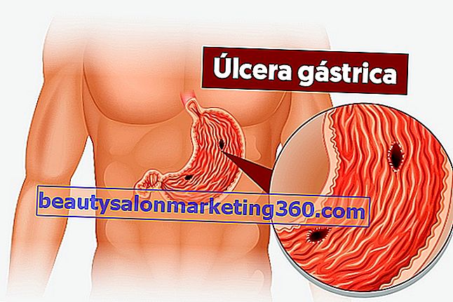 6 sintomas de úlceras no estômago, principais causas e tratamento