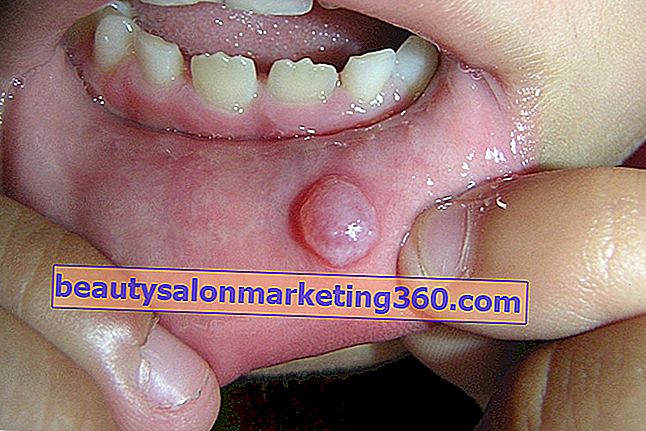 Dolore al tetto della bocca: 5 cause principali e cosa fare