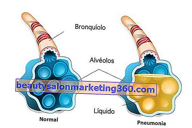 Alveole cu pneumonie