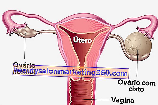 Cos'è la cisti ovarica, i principali sintomi e quali tipi