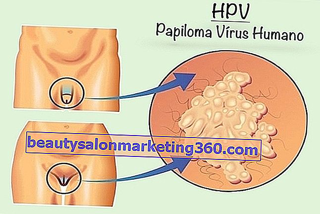HPV : 증상, 전파, 치료 및 치료