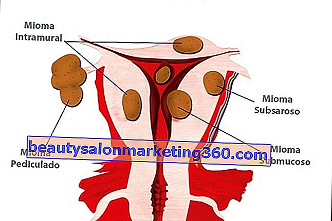 Tipi di fibromi uterini