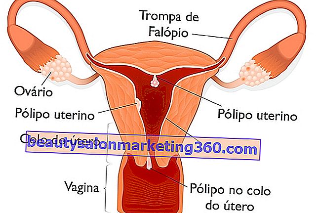 자궁의 폴립이란 무엇이며 주요 원인